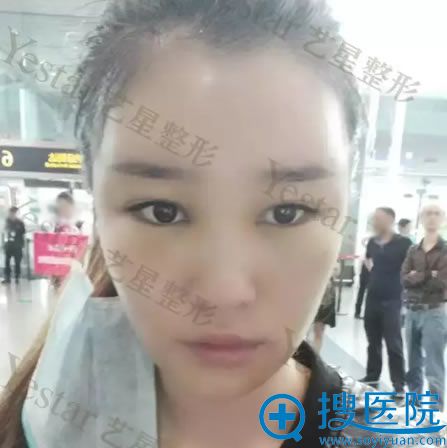 北京艺星自体脂肪填充1天恢复照 北京艺星自体脂肪填充1天恢复照