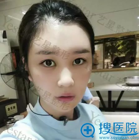 脂肪填充术后15天恢复效果图 脂肪填充术后15天恢复效果图