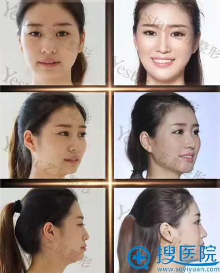 北京艺星自体脂肪填充案例对比图 北京艺星自体脂肪填充案例对比图