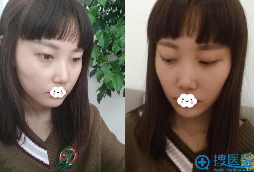 真心赞叹武汉若然整形黄裕智自体脂肪面部填充术后让人过目不忘