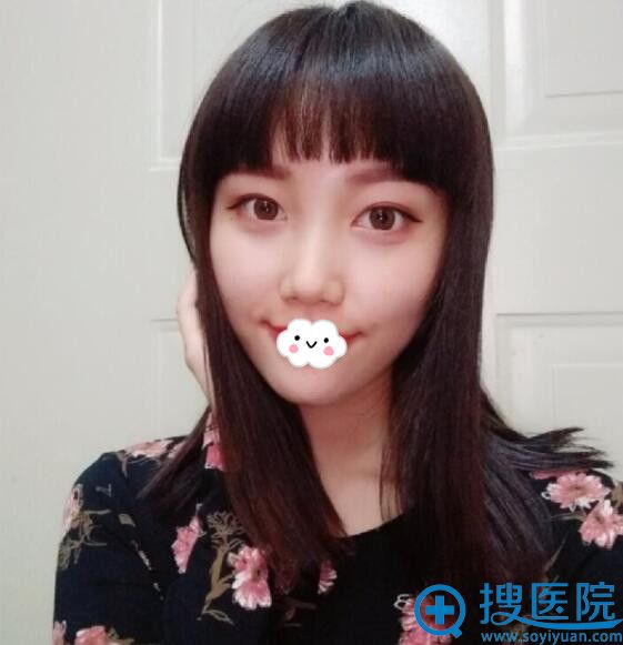 <!--<i data=20240710 data-id=9745></i>-->医疗美容门诊部填充太阳穴案例 <!--<i data=20240710 data-id=9745></i>-->医疗美容门诊部填充太阳穴案例