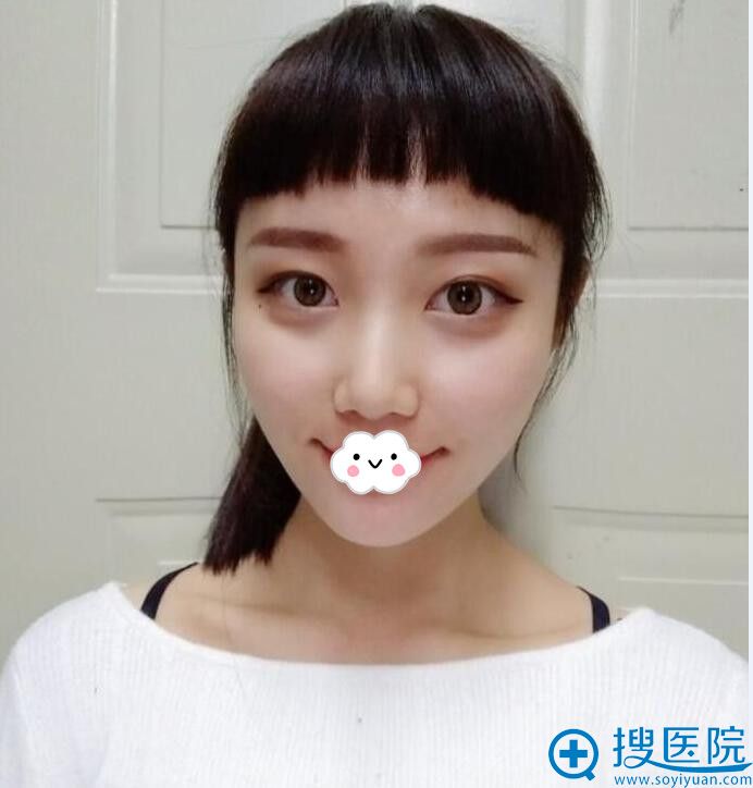 <!--<i data=20240710 data-id=9745></i>-->医疗美容门诊部自体脂肪面部填充案例 <!--<i data=20240710 data-id=9745></i>-->医疗美容门诊部自体脂肪面部填充案例