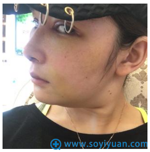 大连新华美天<!--<i data=20240710 data-id=16723></i>-->隆鼻子案例七天啦 大连新华美天<!--<i data=20240710 data-id=16723></i>-->隆鼻子案例七天啦