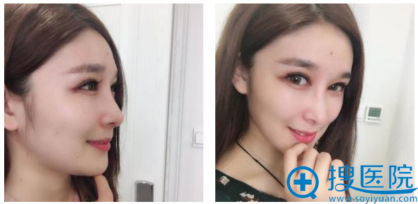 大连新华美天<!--<i data=20240710 data-id=16723></i>-->做鼻子怎么样?看我的隆鼻案例 大连新华美天<!--<i data=20240710 data-id=16723></i>-->做鼻子怎么样?看我的隆鼻案例