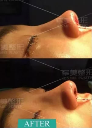 回复私信我要隆鼻案例的亲 重庆军美章小平真人鼻综合案例来啦