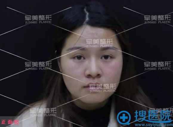 选择军美做隆鼻前的娜娜正面照 选择军美做隆鼻前的娜娜正面照