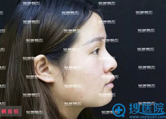 手术前的侧面照 手术前的侧面照
