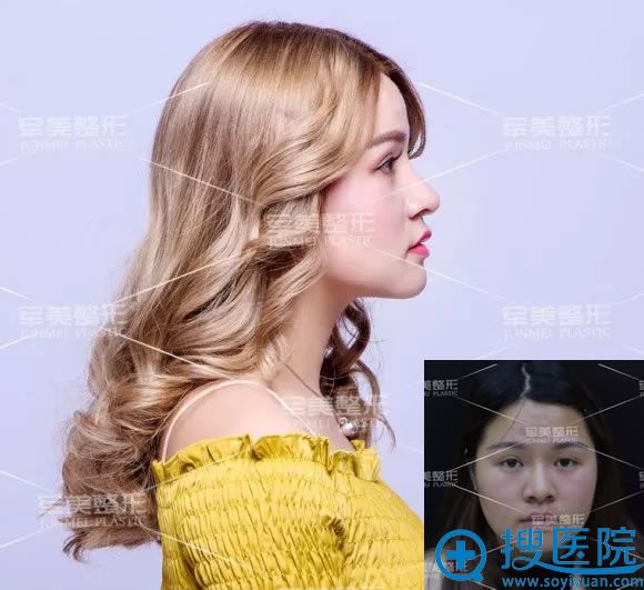 娜娜在军美做隆鼻后2个月恢复照 娜娜在军美做隆鼻后2个月恢复照