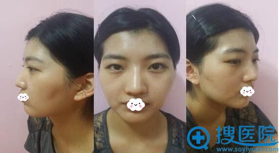韩国巴诺巴奇吴昌铉金学英为我做瘦脸丰额头+眼鼻整形成功换颜