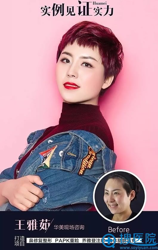 宁夏华美医院鼻部修复案例 宁夏华美医院鼻部修复案例