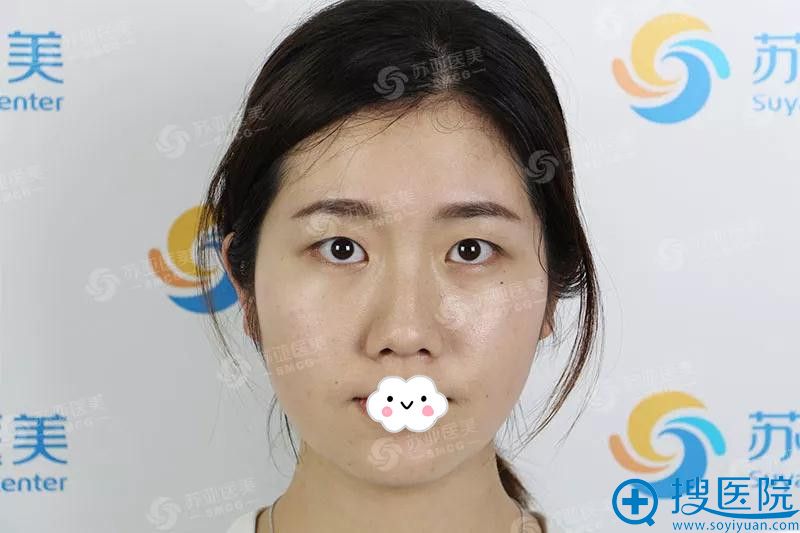 <!--<i data=20240710 data-id=9374></i>-->双眼皮手术前 <!--<i data=20240710 data-id=9374></i>-->双眼皮手术前