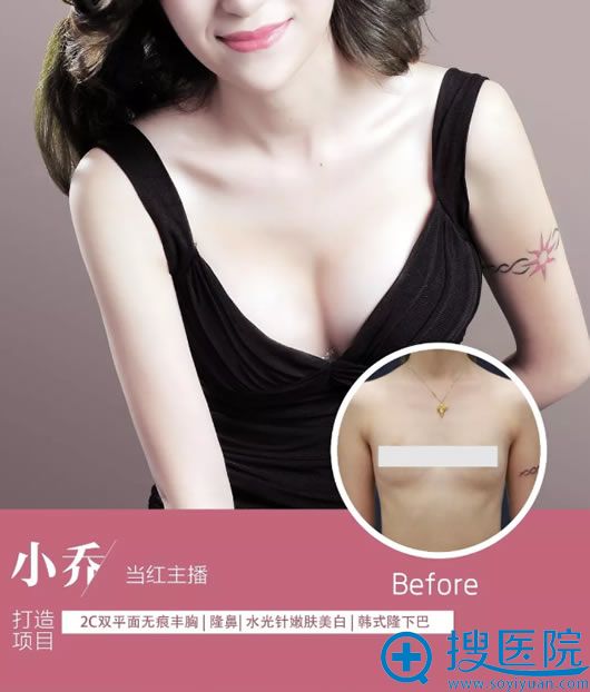 宁夏华美双平面丰胸真人案例 宁夏华美双平面丰胸真人案例