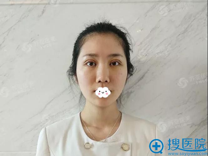 <!--<i data=20240710 data-id=9374></i>-->胡慧敏双眼皮+开眼角案例 <!--<i data=20240710 data-id=9374></i>-->胡慧敏双眼皮+开眼角案例