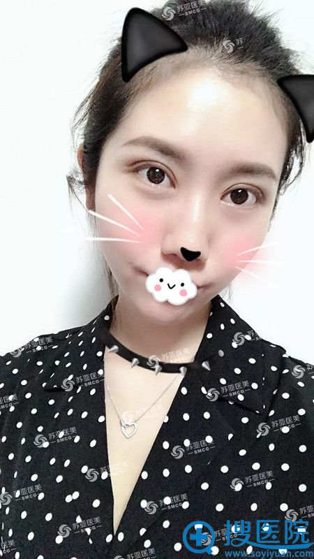 <!--<i data=20240710 data-id=9374></i>-->胡慧敏双眼皮术后10天真人案例 <!--<i data=20240710 data-id=9374></i>-->胡慧敏双眼皮术后10天真人案例