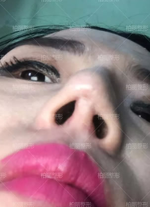北京李劲良做鼻子怎么样?这有一个高难度鼻综合失败修复案例