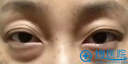 眼袋是什么样子的 眼袋是什么样子的
