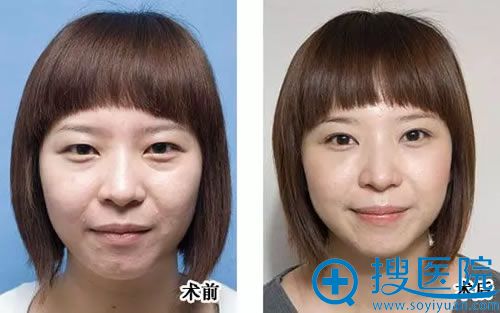 亚馨美莱坞<!--<i data=20240710 data-id=15974></i>-->假性眼袋祛除案例 亚馨美莱坞<!--<i data=20240710 data-id=15974></i>-->假性眼袋祛除案例