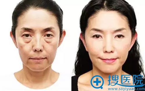 <!--<i data=20240710 data-id=15974></i>-->下睑皮肤松弛眼袋去除案例 <!--<i data=20240710 data-id=15974></i>-->下睑皮肤松弛眼袋去除案例