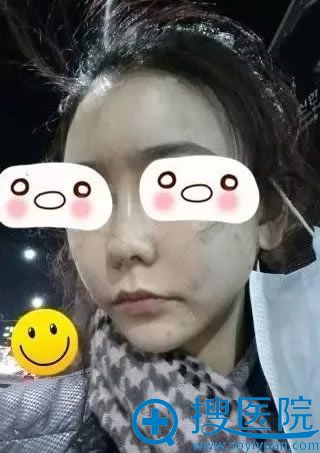 选择济宁韩美做脂肪填充2天后效果 选择济宁韩美做脂肪填充2天后效果