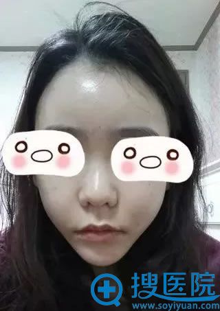 做完脂肪填充面部和隆鼻5天后效果 做完脂肪填充面部和隆鼻5天后效果