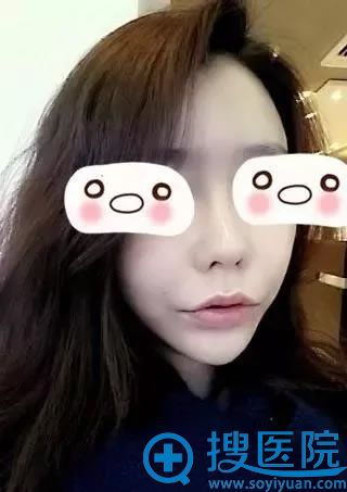 济宁韩美面部脂肪填充3周效果 济宁韩美面部脂肪填充3周效果