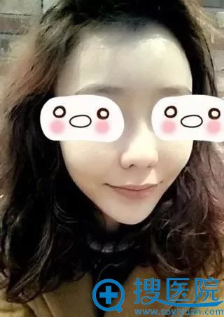 脂肪填充和隆鼻术后2个月恢复图 脂肪填充和隆鼻术后2个月恢复图
