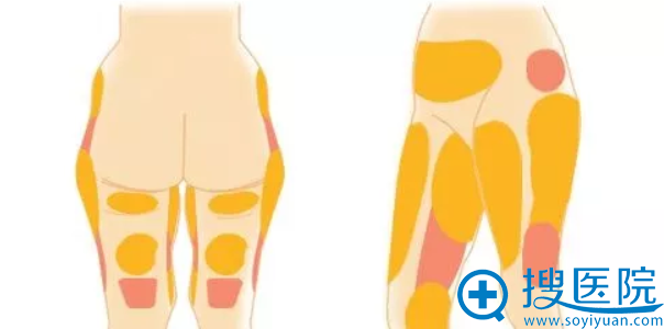 韩国巴诺巴奇腹部/大腿吸脂手术价格6折 夏季优惠活动开启