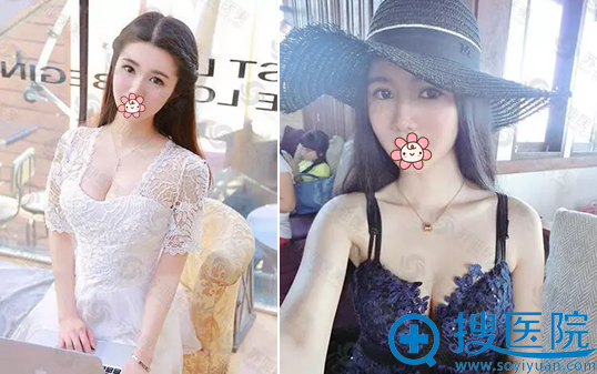 柳成自体脂肪丰胸术后效果 柳成自体脂肪丰胸术后效果