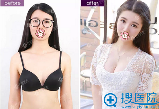 石家庄苏亚美联臣柳成脂肪丰胸术前术后对比 石家庄苏亚美联臣柳成脂肪丰胸术前术后对比