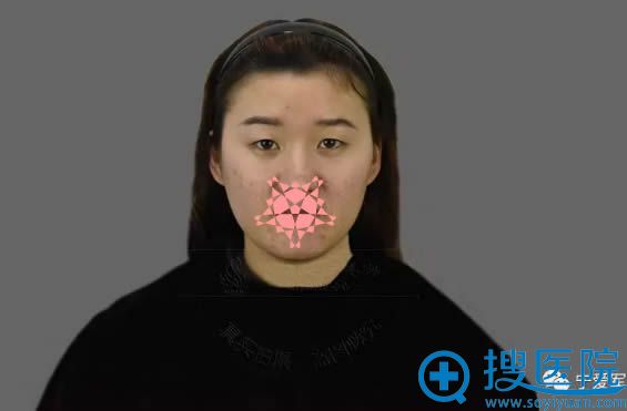 做双眼皮术前照 做双眼皮术前照