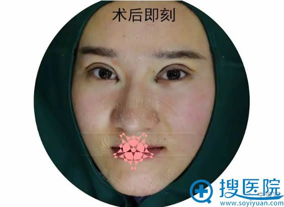 切开双眼皮术后即刻效果图 切开双眼皮术后即刻效果图