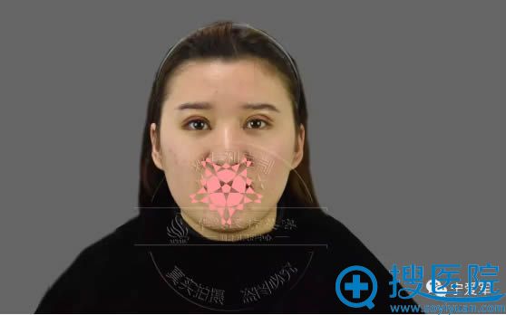 全切双眼皮术后第3天的美照 全切双眼皮术后第3天的美照