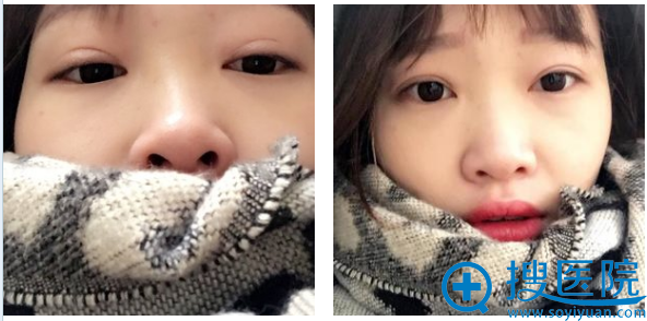 ��ɳ�����﷼��˫��Ƥ�������۱���Ч��