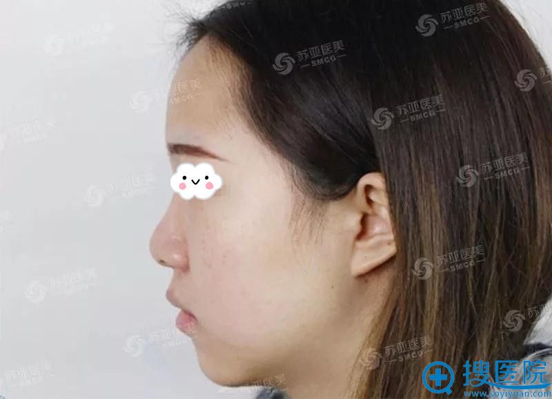 看张蕾做的海欧鼻综合案例 就知道无锡苏亚美联臣隆鼻好不好?