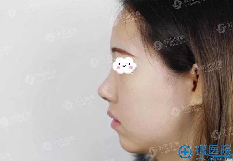 <!--<i data=20240710 data-id=9374></i>-->整形医院海鸥鼻综合效果 <!--<i data=20240710 data-id=9374></i>-->整形医院海鸥鼻综合效果