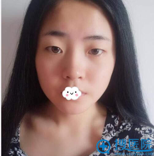 致西安施尔绮王驰的一封信:你为我做的埋线双眼皮让我美丽重生