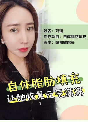 想做自体脂肪填充可以参考青岛壹美魏邦敏给我做填充后20天效果