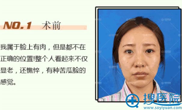自体脂肪填充前 自体脂肪填充前