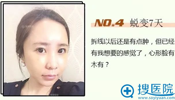 做自体脂肪填充全脸7天恢复效果 做自体脂肪填充全脸7天恢复效果