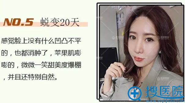 自体脂肪填充20天恢复的样子 自体脂肪填充20天恢复的样子