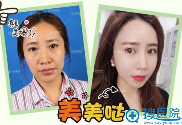青岛壹美魏邦敏脂肪填充案例 青岛壹美魏邦敏脂肪填充案例
