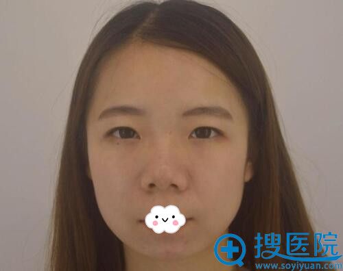 评论下武汉美立方胡江伟为我玻尿酸隆鼻+垫下巴效果算失败吗?