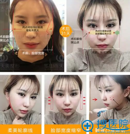 <!--<i data=20240710 data-id=10206></i>-->连天美高明俊颧骨内推案例 <!--<i data=20240710 data-id=10206></i>-->连天美高明俊颧骨内推案例