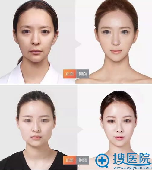 <!--<i data=20240710 data-id=10206></i>-->连天美高俊明下颌角案例 <!--<i data=20240710 data-id=10206></i>-->连天美高俊明下颌角案例