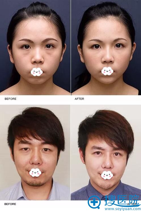 南京华美假体垫下巴案例效果对比 南京华美假体垫下巴案例效果对比