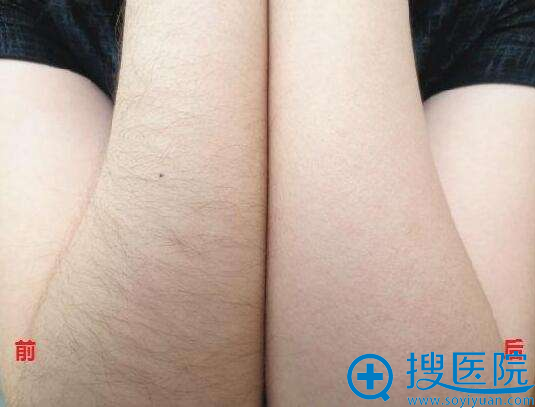 听贵阳华美讲解冰点脱毛的特点与注意事项 脱光体验1元起