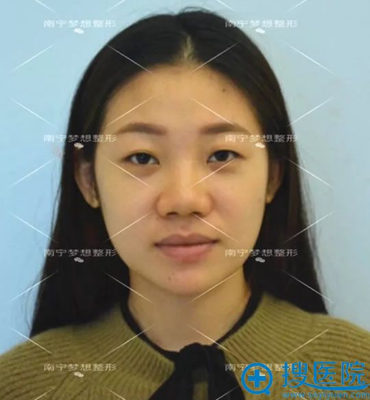 找工作室做的线雕隆鼻失败照片 找工作室做的线雕隆鼻失败照片
