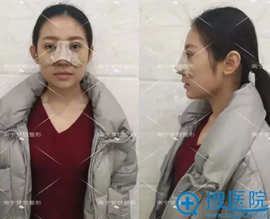 选南宁梦想做鼻修复手术3天效果 选南宁梦想做鼻修复手术3天效果