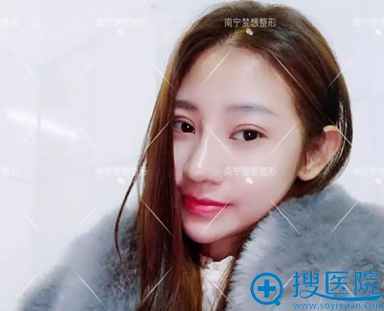 找唐超院长做鼻综合7天拆线效果 找唐超院长做鼻综合7天拆线效果