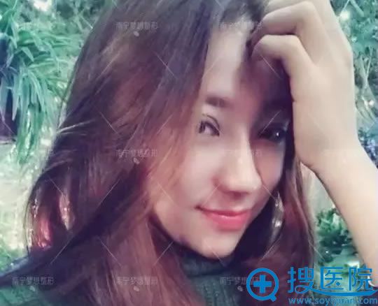 线雕隆鼻修复术后1个月效果 线雕隆鼻修复术后1个月效果